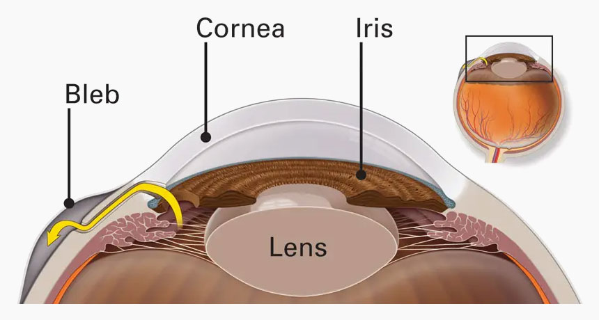 Glaucoma- Bannan Eye- Our Services Include Glaucoma Diagnosis And Treatment